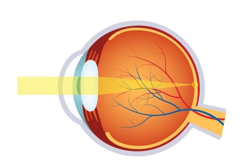 que es la miopia en el fondo del ojo
