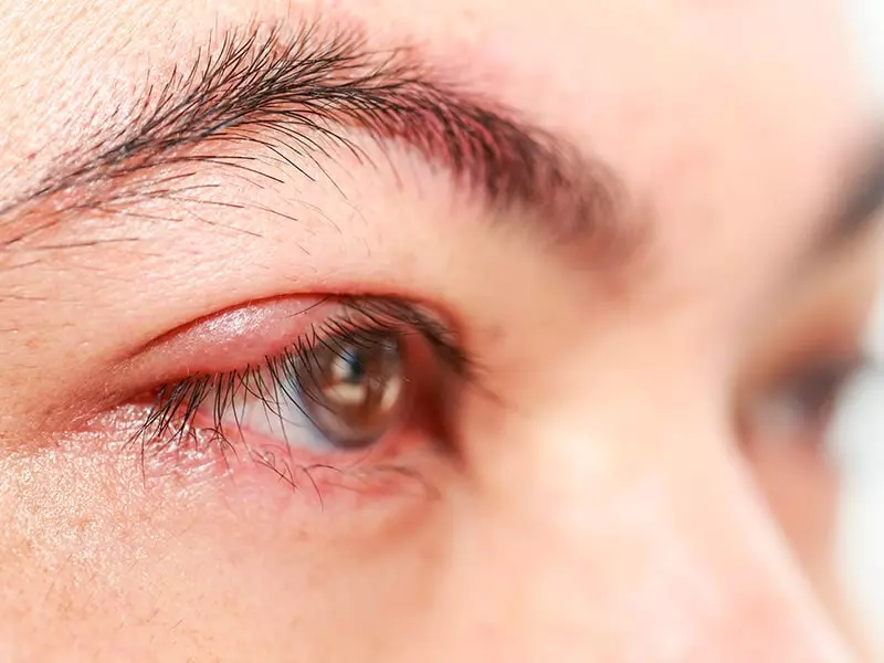 que es el chalazion en el ojo y los sintomas