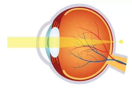 diferencia entre miopia hipermetropía y astigmatismo en los ojos