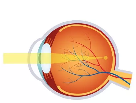 diferencia entre miopia hipermetropía y astigmatismo en el ojo